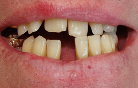 image of teeth before the treatment