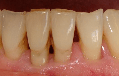 Claregate Dental Practice | Invisalign Braces Wolverhampton | Clear Braces Wolverhampton