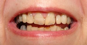 Teeth whitening before treatment in Wolverhampton