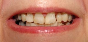 Teeth whitening after treatment