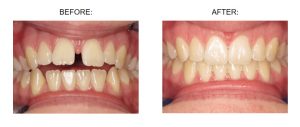 Before and after a smile makeover at Claregate Dental Practice in Wolverhampton