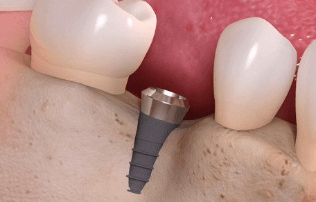 A diagram of a Dental Implant fused into the jaw