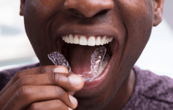 Man putting in his Invisalign Clear Aligners at Wolverhampton dental practice