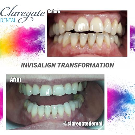 Invisalign Clear Braces Before & Afters