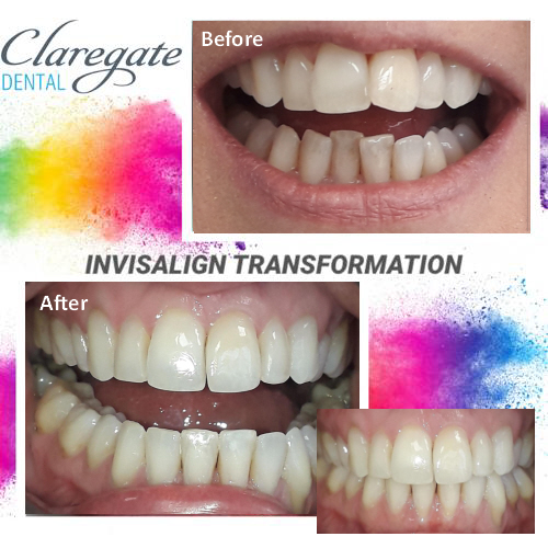 Invisalign Clear Braces Before & Afters