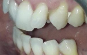 Invisalign braces in Wolverhampton