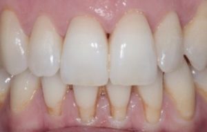Clear braces in Wolverhampton