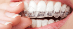 Someone putting in their Invisalign aligners