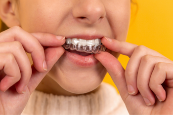 Woman placing invisible Invisalign braces in mouth