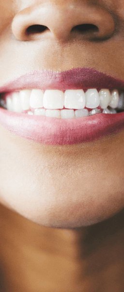 Woman with Invisalign treatment in Wolverhampton