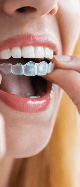 Invisalign treatment in Wolverhampton