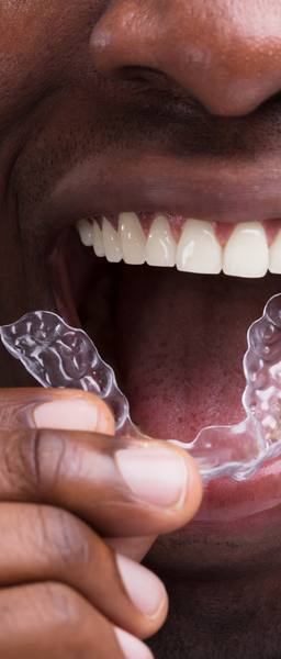 Invisalign being inserted into patient's mouth in Wolverhampton