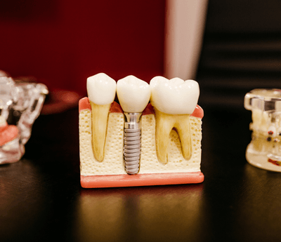 Dental implant mould in Wolverhampton