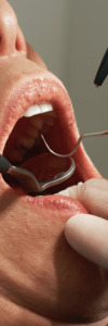 woman with bleeding gums with her mouth open at Wolverhampton dental practice