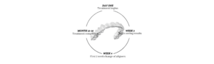 Invisalign clear braces process in Wolverhampton dental practice