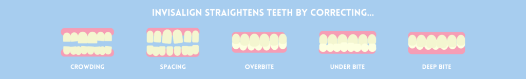 Invisalign straightens teeth by correcting