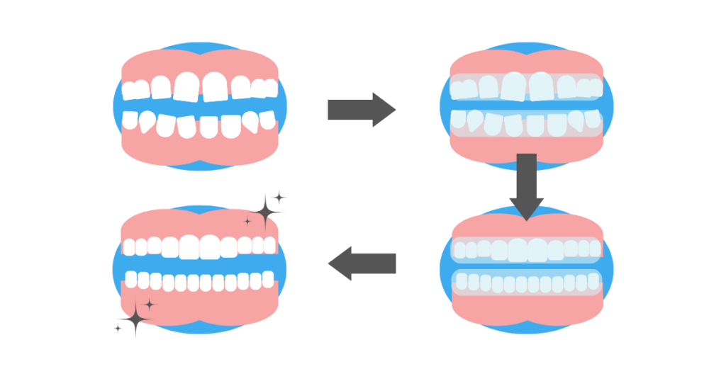 the Invisalign process in Wolverhampton