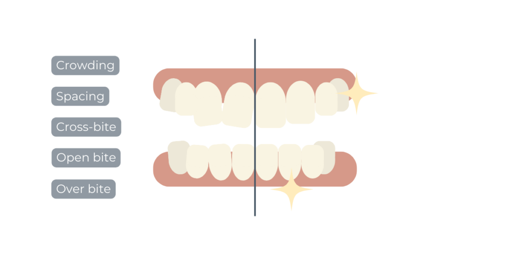 Before and after orthodontic treatment at Claregate Dental Practice