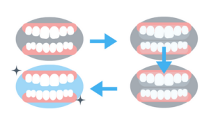 Invisalign braces process at Wolverhampton dental practice